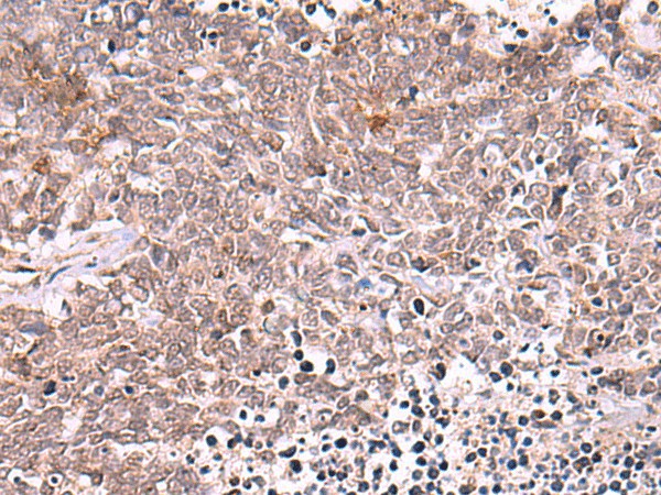 Immunohistochemistry of paraffin-embedded Human lung cancer tissue  using TRMT12 Polyclonal Antibody at dilution of 1:80(?200)