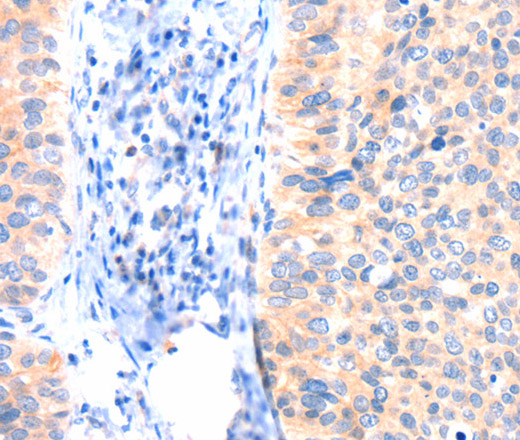 Immunohistochemistry of paraffin-embedded Human cervical cancer tissue using ANK3 Polyclonal Antibody at dilution 1:50