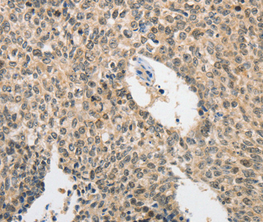 Immunohistochemistry of paraffin-embedded Human lung cancer tissue using ATG5 Polyclonal Antibody at dilution 1:40