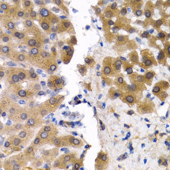 Immunohistochemistry of paraffin-embedded Human liver cancer using SCP2 Polyclonal Antibody at dilution of  1:200 (40x lens).