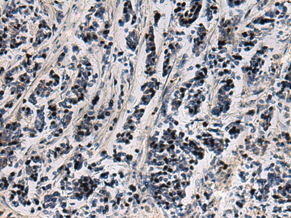 Immunohistochemistry of paraffin-embedded Human breast cancer tissue  using SNIP1 Polyclonal Antibody at dilution of 1:80(?200)