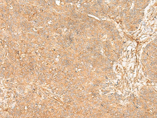 Immunohistochemistry of paraffin-embedded Human ovarian cancer tissue  using FLNC Polyclonal Antibody at dilution of 1:35(?200)