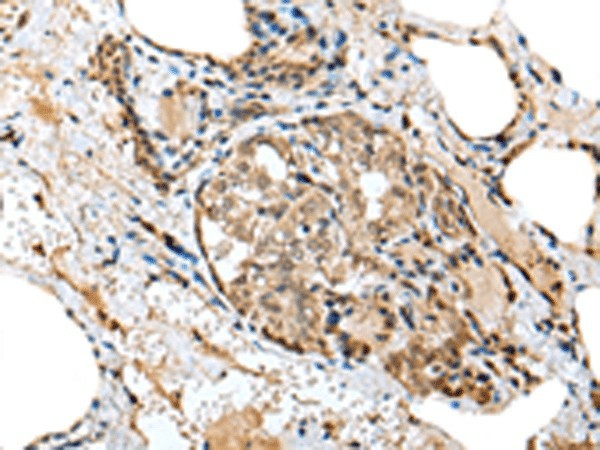 Immunohistochemistry of paraffin-embedded Human thyroid cancer tissue  using TPPP Polyclonal Antibody at dilution of 1:25(?200)