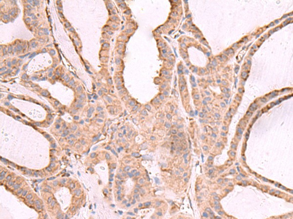 Immunohistochemistry of paraffin-embedded Human thyroid cancer tissue  using EEF1D Polyclonal Antibody at dilution of 1:65(?200)