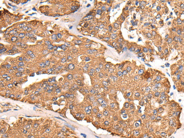 Immunohistochemistry of paraffin-embedded Human liver cancer tissue  using ATP5C1 Polyclonal Antibody at dilution of 1:55(?200)