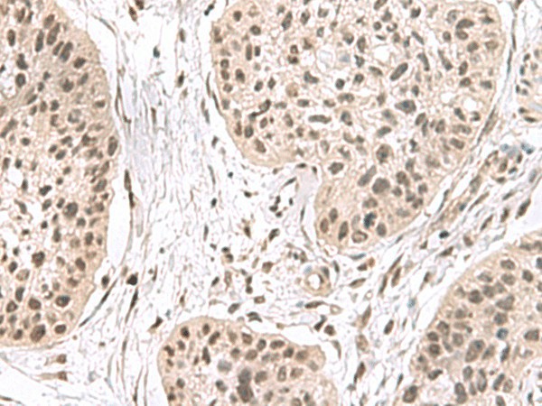 Immunohistochemistry of paraffin-embedded Human esophagus cancer tissue  using ERH Polyclonal Antibody at dilution of 1:55(?200)