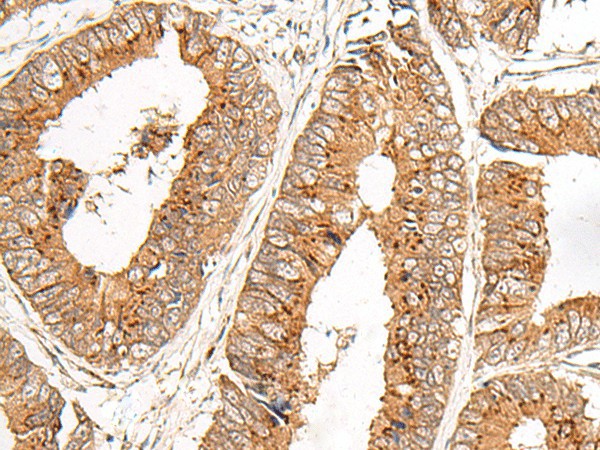 Immunohistochemistry of paraffin-embedded Human colorectal cancer tissue  using FAM84B Polyclonal Antibody at dilution of 1:45(?200)