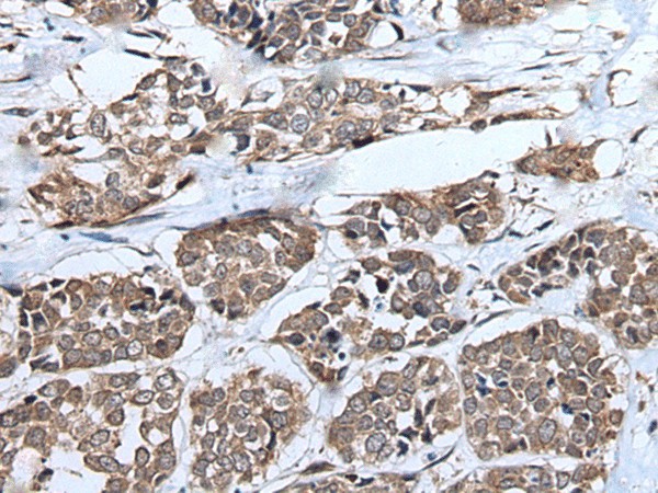 Immunohistochemistry of paraffin-embedded Human esophagus cancer tissue  using UBE4B Polyclonal Antibody at dilution of 1:40(?200)