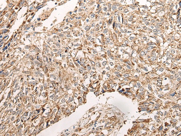 Immunohistochemistry of paraffin-embedded Human lung cancer tissue  using NDUFB11 Polyclonal Antibody at dilution of 1:95(?200)