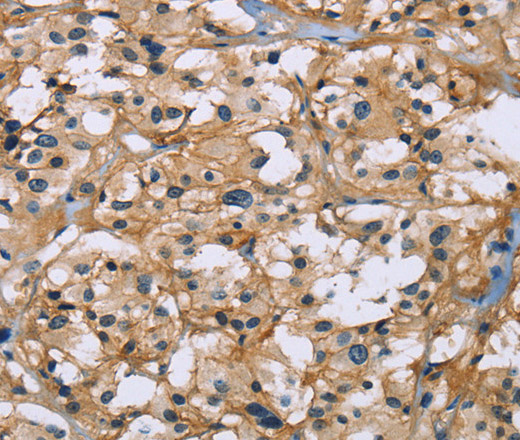 Immunohistochemistry of paraffin-embedded Human thyroid cancer tissue using BSG Polyclonal Antibody at dilution 1:60