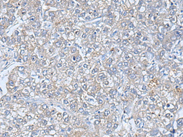 Immunohistochemistry of paraffin-embedded Human liver cancer tissue  using TREM1 Polyclonal Antibody at dilution of 1:50(?200)