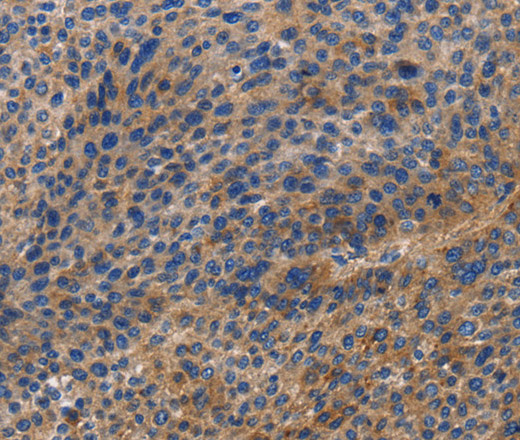 Immunohistochemistry of paraffin-embedded Human liver cancer tissue using DOK4 Polyclonal Antibody at dilution 1:60