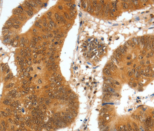 Immunohistochemistry of paraffin-embedded Human colon cancer tissue using SPDEF Polyclonal Antibody at dilution 1:60