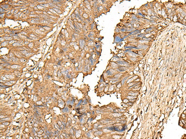 Immunohistochemistry of paraffin-embedded Human colorectal cancer tissue  using UBE2A Polyclonal Antibody at dilution of 1:55(?200)