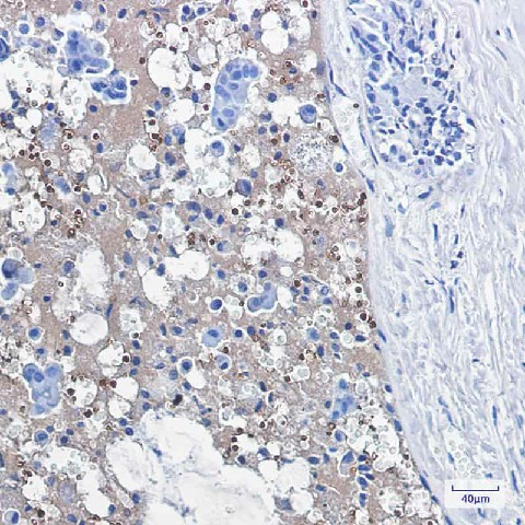 Immunohistochemistry of Catalase in paraffin-embedded Human breast cancer tissue using Catalase Rabbit mAb at dilution 1:100