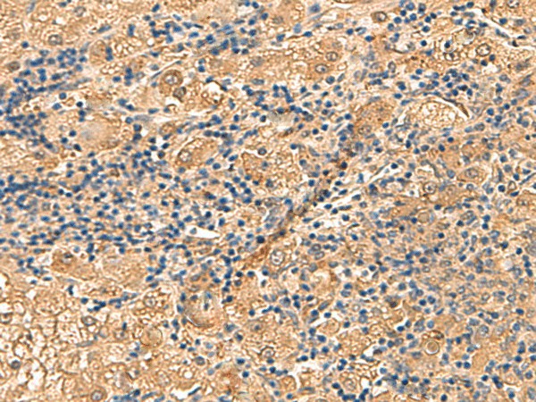 Immunohistochemistry of paraffin-embedded Human liver cancer tissue  using PTH1R Polyclonal Antibody at dilution of 1:55(?200)