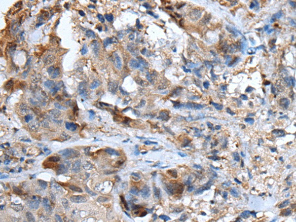 Immunohistochemistry of paraffin-embedded Human breast cancer tissue  using CXCL5 Polyclonal Antibody at dilution of 1:50(?200)