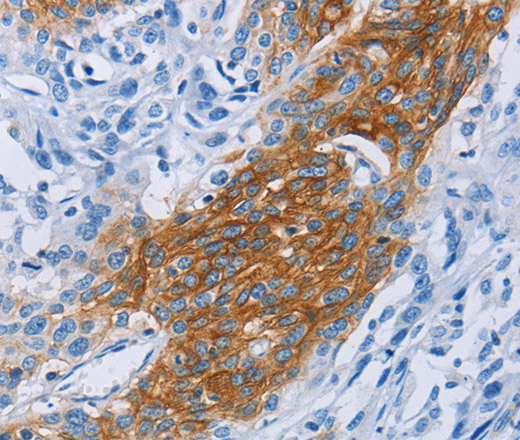 Immunohistochemistry of paraffin-embedded Human esophagus cancer tissue using CCR9 Polyclonal Antibody at dilution 1:60