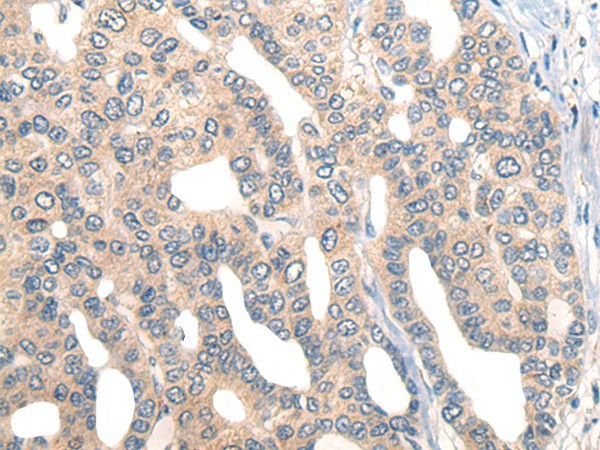 Immunohistochemistry of paraffin-embedded Human liver cancer tissue  using CORO2B Polyclonal Antibody at dilution of 1:50(?200)