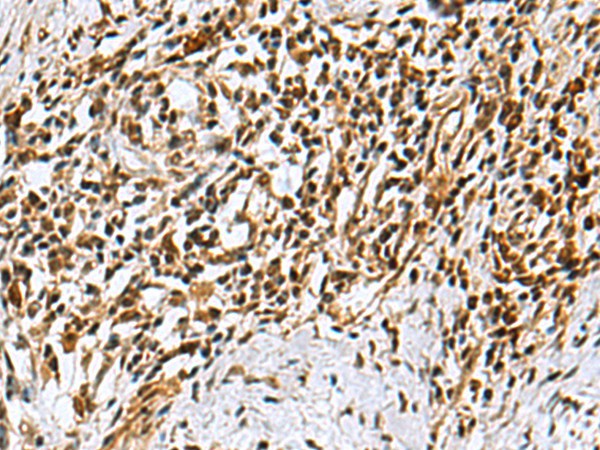 Immunohistochemistry of paraffin-embedded Human esophagus cancer tissue  using KDM2B Polyclonal Antibody at dilution of 1:40(?200)