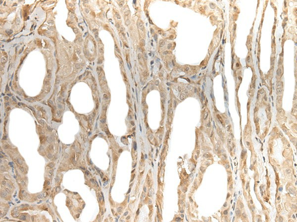 Immunohistochemistry of paraffin-embedded Human thyroid cancer tissue  using ZBTB18 Polyclonal Antibody at dilution of 1:50(?200)