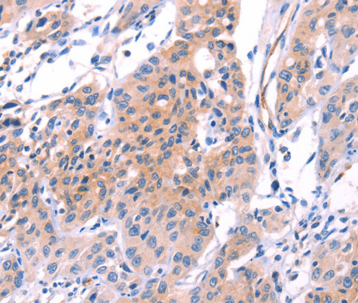 Immunohistochemistry of paraffin-embedded Human lung cancer tissue using VWF Polyclonal Antibody at dilution 1:50