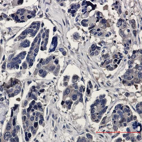 Immunohistochemistry of ERK2 in paraffin-embedded Human Cholangiocarcinoma using ERK2 Rabbit mAb at dilution 1:20