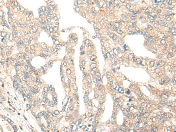 Immunohistochemistry of paraffin-embedded Human liver cancer tissue  using DCP2 Polyclonal Antibody at dilution of 1:45(?200)