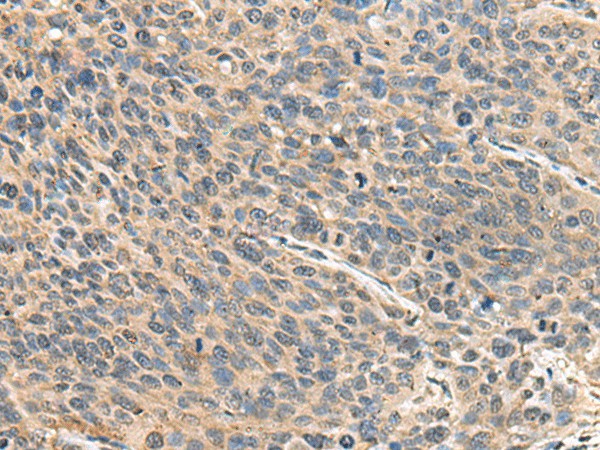 Immunohistochemistry of paraffin-embedded Human cervical cancer tissue  using RPS14 Polyclonal Antibody at dilution of 1:50(?200)