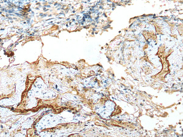 Immunohistochemistry of paraffin-embedded Human cervical cancer tissue  using LDHD Polyclonal Antibody at dilution of 1:120(?200)