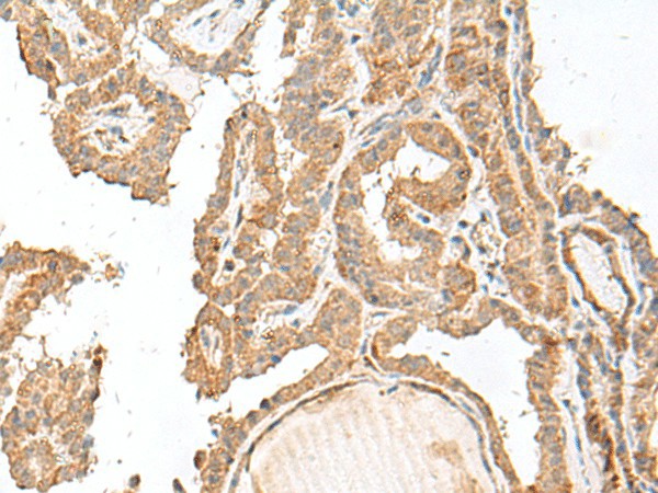 Immunohistochemistry of paraffin-embedded Human thyroid cancer tissue  using GART Polyclonal Antibody at dilution of 1:30(?200)