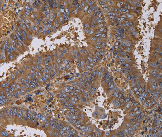 Immunohistochemistry of paraffin-embedded Human colon cancer using FADS1 Polyclonal Antibody at dilution of 1:60