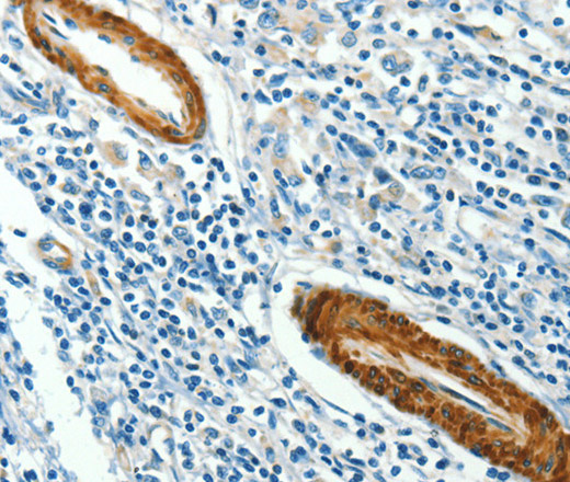 Immunohistochemistry of paraffin-embedded Human gastic cancer using CAV3 Polyclonal Antibody at dilution of 1:40