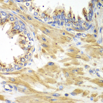 Immunohistochemistry of paraffin-embedded human prostate using PICK1 Polyclonal Antibody at dilution of 1:100 (40x lens).Perform microwave antigen retrieval with 10 mM PBS buffer pH 7.2 before commencing with IHC staining protocol.