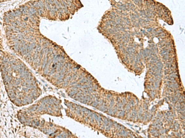 Immunohistochemistry of paraffin-embedded Human colorectal cancer tissue  using CDC20 Polyclonal Antibody at dilution of 1:50(?200)