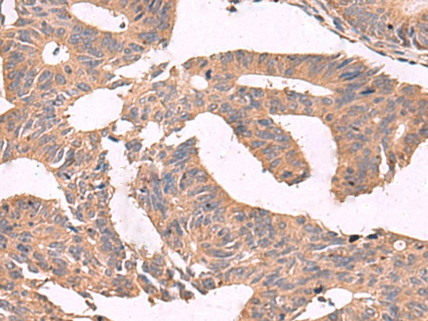 Immunohistochemistry of paraffin-embedded Human colorectal cancer tissue  using MGP Polyclonal Antibody at dilution of 1:75(?200)