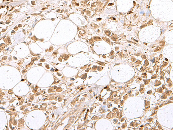 Immunohistochemistry of paraffin-embedded Human breast cancer tissue  using RBFOX2 Polyclonal Antibody at dilution of 1:80(?200)