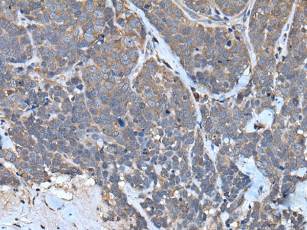 Immunohistochemistry of paraffin-embedded Human thyroid cancer tissue  using TNMD Polyclonal Antibody at dilution of 1:40(?200)