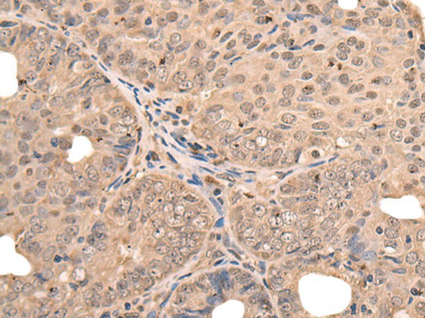 Immunohistochemistry of paraffin-embedded Human ovarian cancer tissue  using ATF7 Polyclonal Antibody at dilution of 1:40(?200)