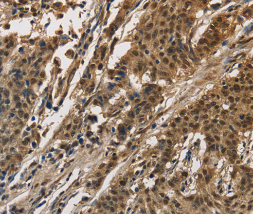 Immunohistochemistry of paraffin-embedded Human gasrtic cancer tissue using CCAR1 Polyclonal Antibody at dilution 1:40