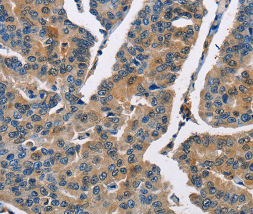 Immunohistochemistry of paraffin-embedded Human breast cancer using CBR1 Polyclonal Antibody at dilution of 1:40