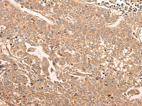 Immunohistochemistry of paraffin-embedded Human liver cancer tissue  using LDAH Polyclonal Antibody at dilution of 1:55(?200)