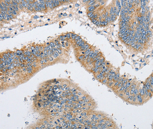 Immunohistochemistry of paraffin-embedded Human colon cancer using ARHGEF9 Polyclonal Antibody at dilution of 1:50