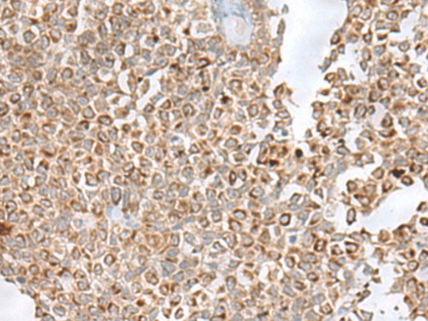 Immunohistochemistry of paraffin-embedded Human ovarian cancer tissue  using GLYAT Polyclonal Antibody at dilution of 1:50(?200)