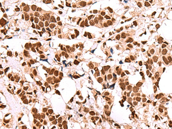 Immunohistochemistry of paraffin-embedded Human breast cancer tissue  using FOXK2 Polyclonal Antibody at dilution of 1:60(?200)