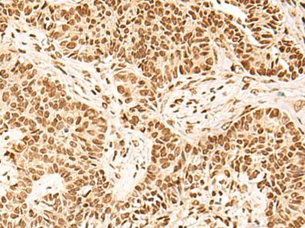 Immunohistochemistry of paraffin-embedded Human ovarian cancer tissue  using HOXC13 Polyclonal Antibody at dilution of 1:60(?200)