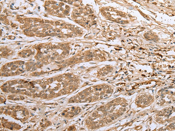 Immunohistochemistry of paraffin-embedded Human esophagus cancer tissue  using ATXN7L3 Polyclonal Antibody at dilution of 1:40(?200)