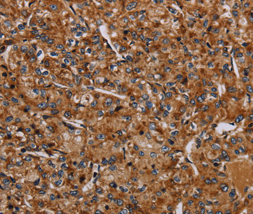 Immunohistochemistry of paraffin-embedded Human prostate cancer using NDUFA8 Polyclonal Antibody at dilution of 1:40