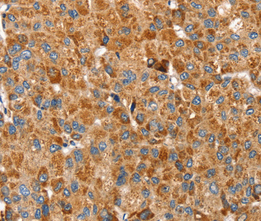 Immunohistochemistry of paraffin-embedded Human liver cancer using SSBP1 Polyclonal Antibody at dilution of 1:30