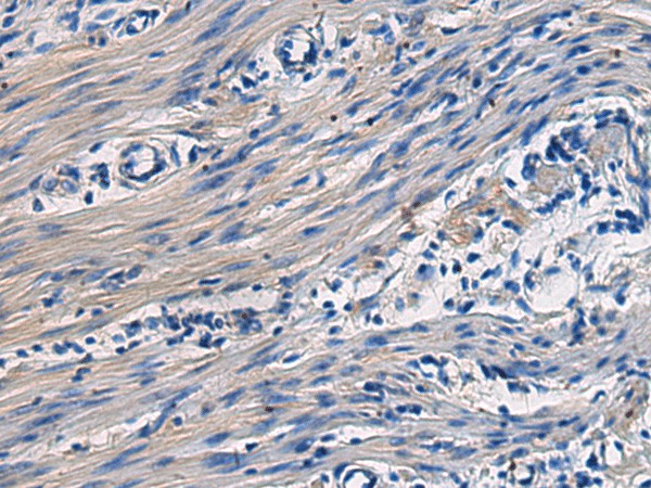 Immunohistochemistry of paraffin-embedded Human colorectal cancer tissue  using COL17A1 Polyclonal Antibody at dilution of 1:50(?200)